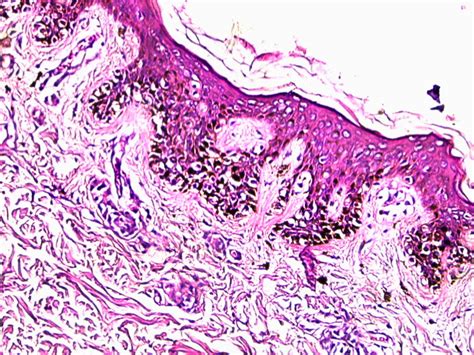 junctional melanocytic nevus, dysplastic type with severe atypia