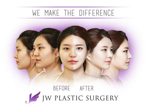 jw-plastic-surgery-korea