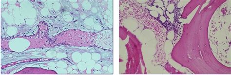 käkben inflammation