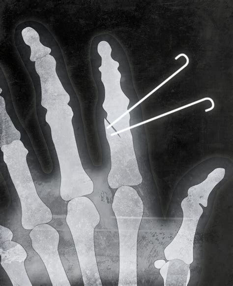 K Wire Fixation
