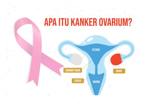 kanker ovarium