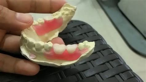 kekurangan gigi palsu valplast