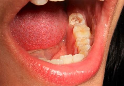 kenapa gigi berlubang sakit