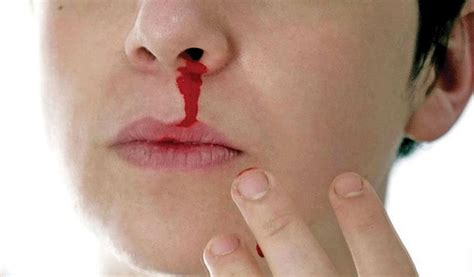 kenapa hidung berdarah saat pilek