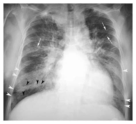 Kerley C Lines