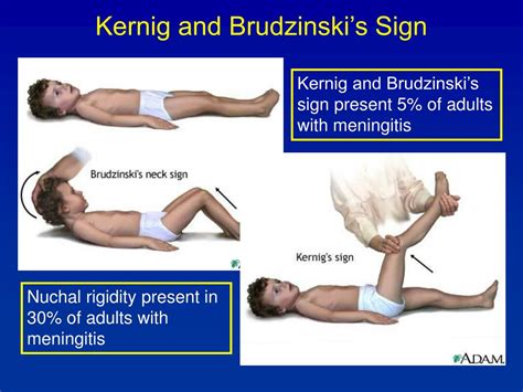 Kernig And Brudzinski