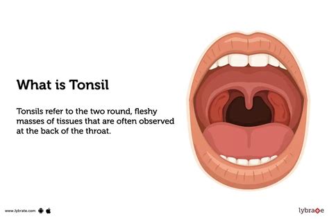kissing tonsils medical term treatment