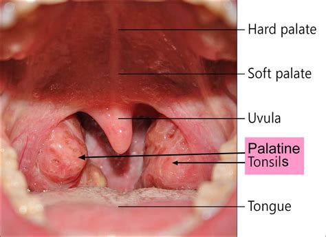 kissing tonsils medical term vs