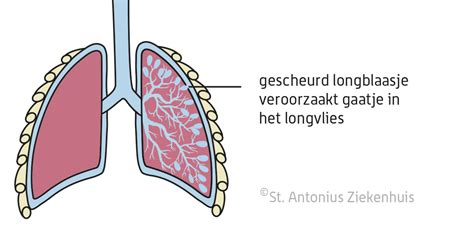 klaplong in het engels