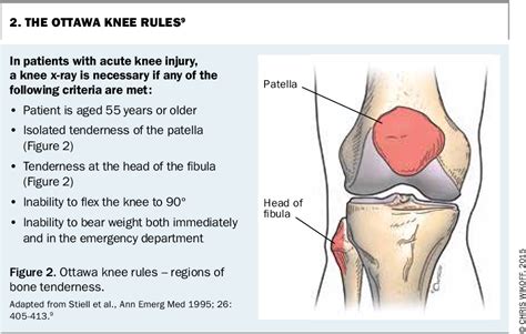 Knee Ottawa Rules