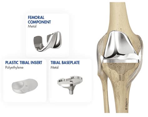 Knee Replacement New Technology