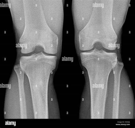Knee X Ray