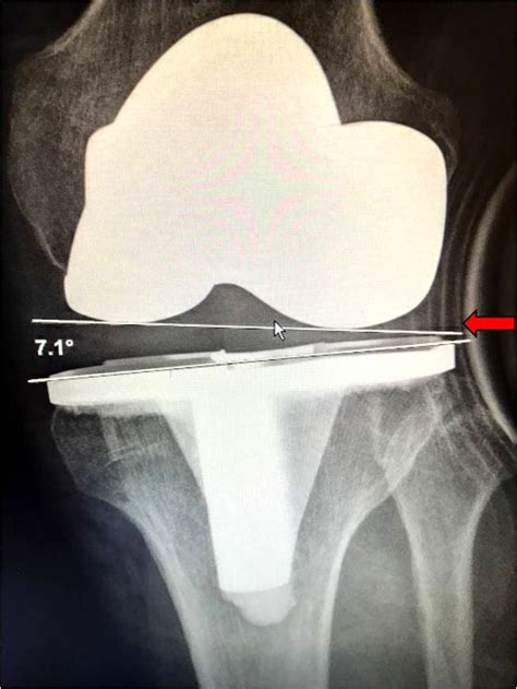 knieprothese complicaties