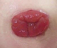 komplikationer efter ägguttag