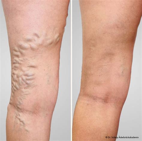 komplikationer efter åderbråcksoperation