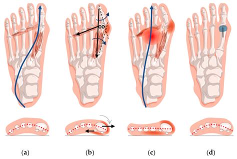 komplikationer efter hallux valgus operation
