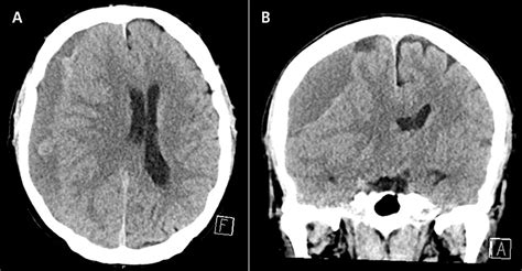 kroniskt subduralhematom