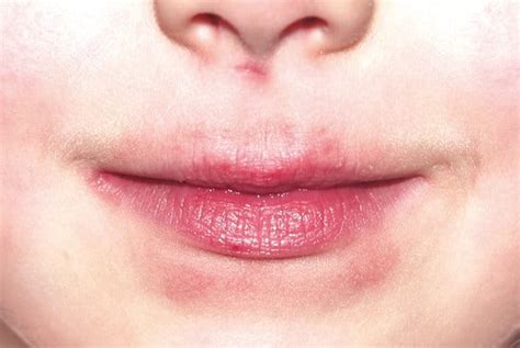 läppinflammation behandling