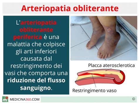 Download L Arteriopatia Obliterante Periferica Cronica Degli Arti 