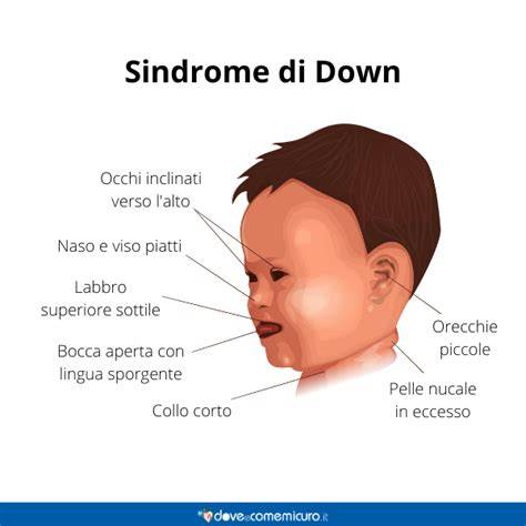 la sindrome di down