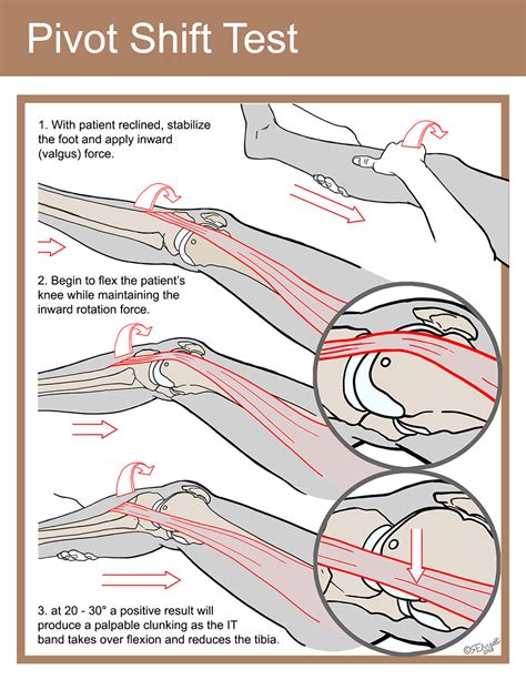lachmans test draglåda pivot shift