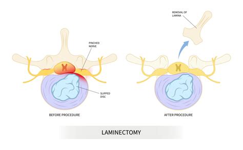 Laminectomy Vs Discectomy