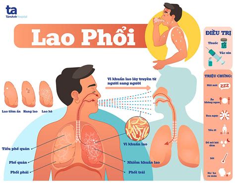 lao phổi | Bnh lao phi l g Nguyn nhn