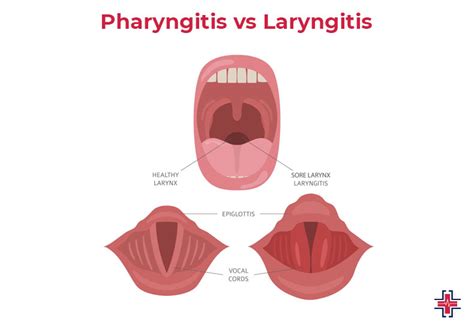 Laryngitis Vs Pharyngitis