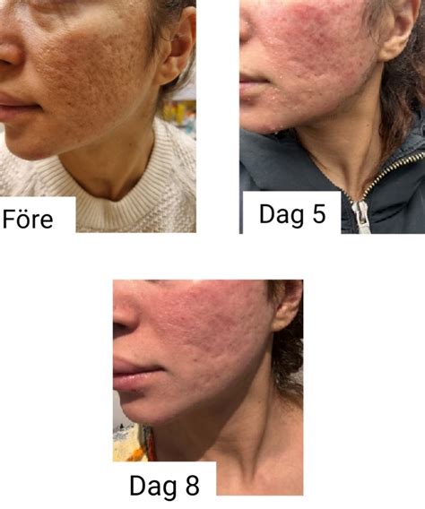 laser behandling ansikte