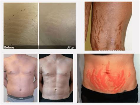 Laser Therapy Stretch Marks