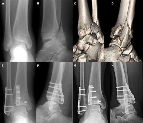 lateral malleolus fracture recovery årsak