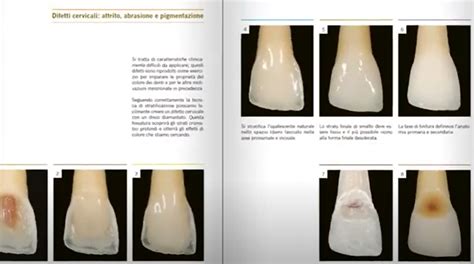 Read Layers An Atlas Of Composite Resin Stratification Free 