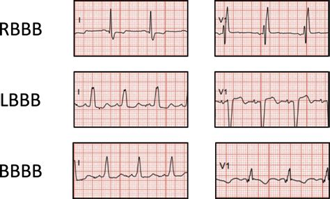 Lbbb Icd 10