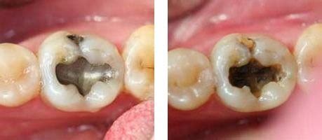 leaking tooth filling symptoms