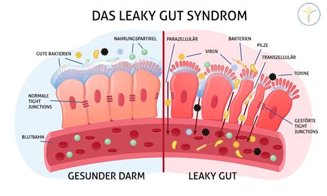 leaky gut den durchlassigen darm heilen