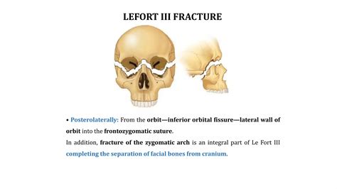 Lefort Fractures Require