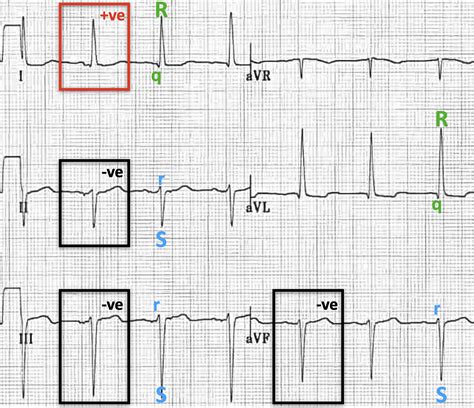 Left Ant Fascicular Block Ecg