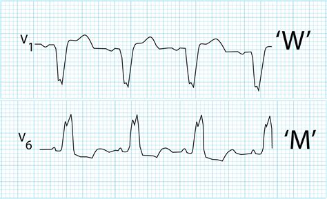 Left Bundle Branch Block Icd 10