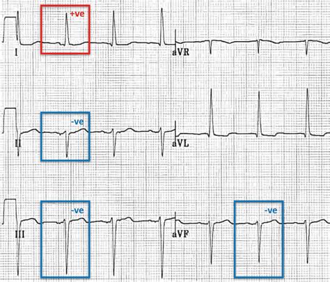 Left Deviation Ecg