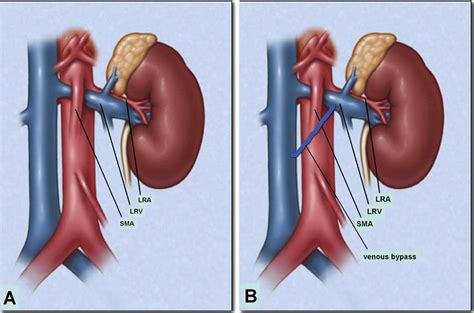 Left Renal Vein Compression