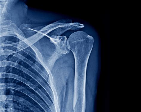 Left Shoulder X Ray