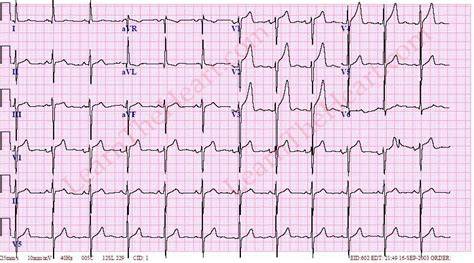 Left Ventricular Hypertrophy Ecg