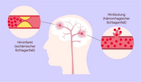 leichter schlaganfall nachbehandlung
