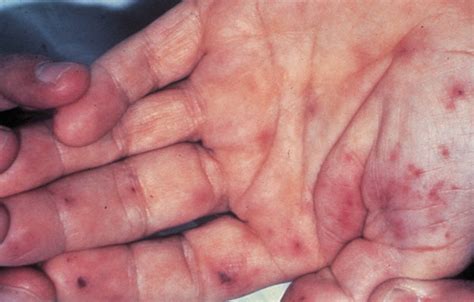Lesiones De Janeway