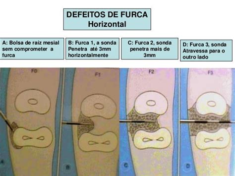 Lesão De Furca