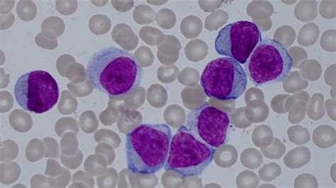 leukemi vuxna överlevnad