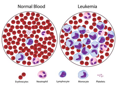 leukemia adalah