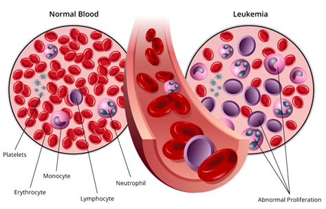 leukemia how it is caused
