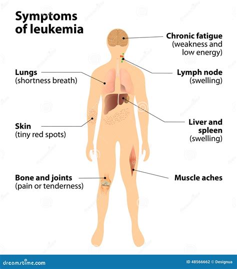 leukemie symptomen