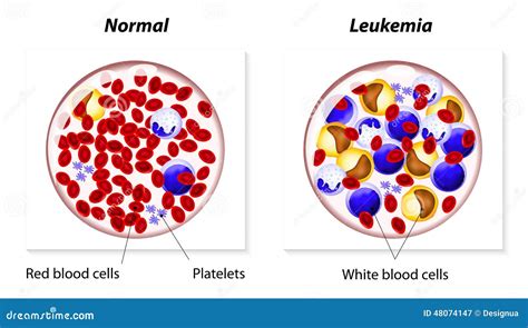 leukemie type